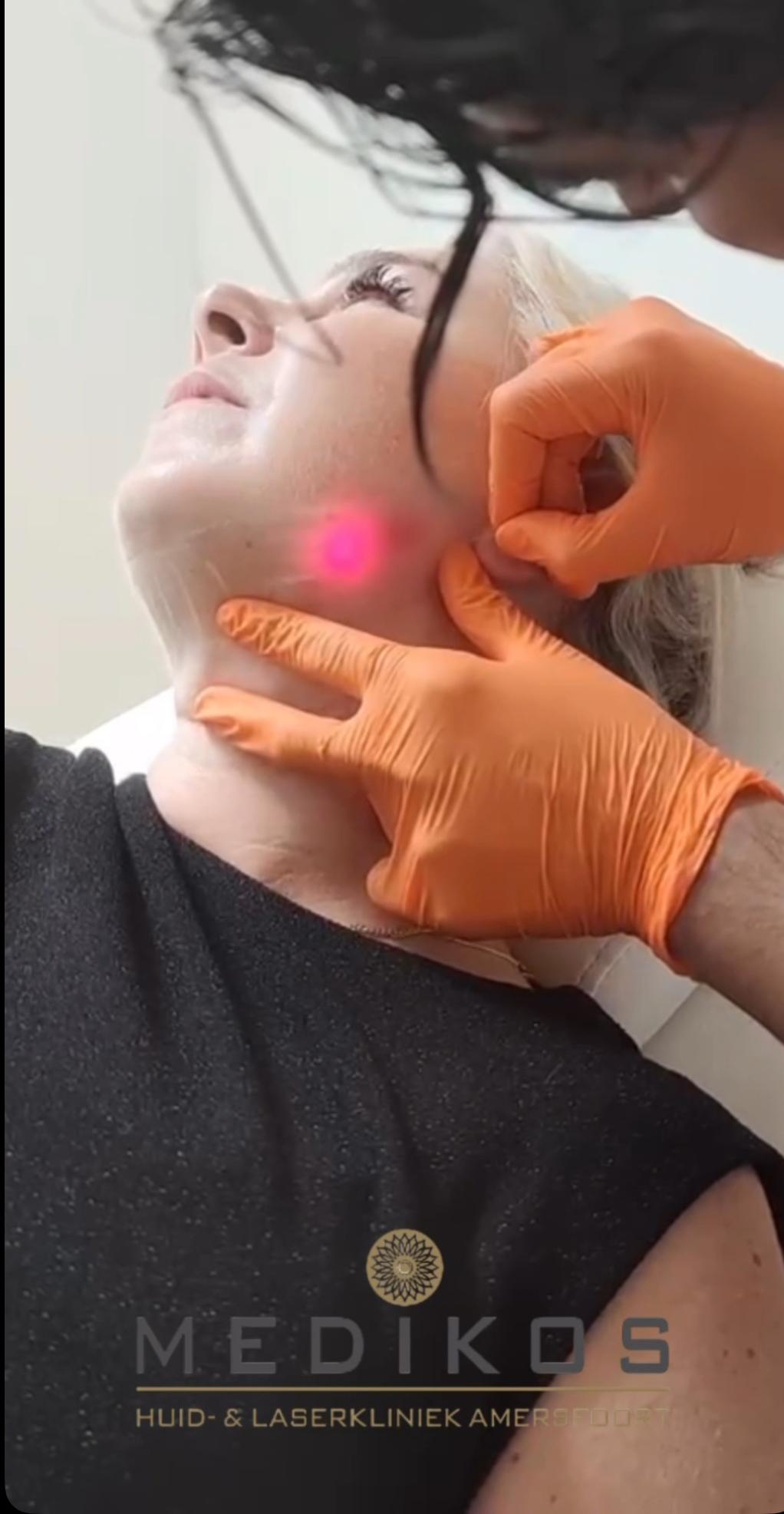 Injectables behandeling voor rimpels in Amersfoort bij Medikos Huid- & Laserkliniek Amersfoort