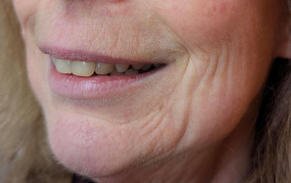 Marionetlijnen foto van BLOY Institute Eindhoven (voor)