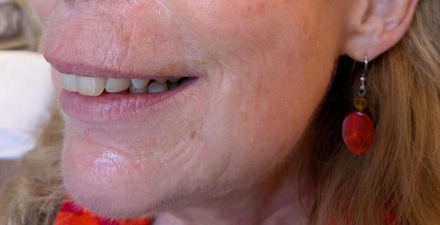 Marionetlijnen foto van BLOY Institute Eindhoven (na)