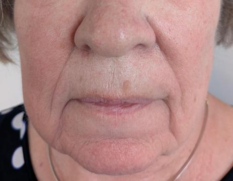 Marionetlijnen foto van BLOY Institute Eindhoven (voor)