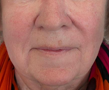 Marionetlijnen foto van BLOY Institute Eindhoven (na)