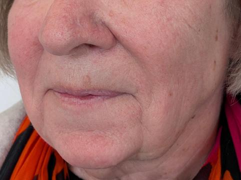 Marionetlijnen foto van BLOY Institute Eindhoven (na)