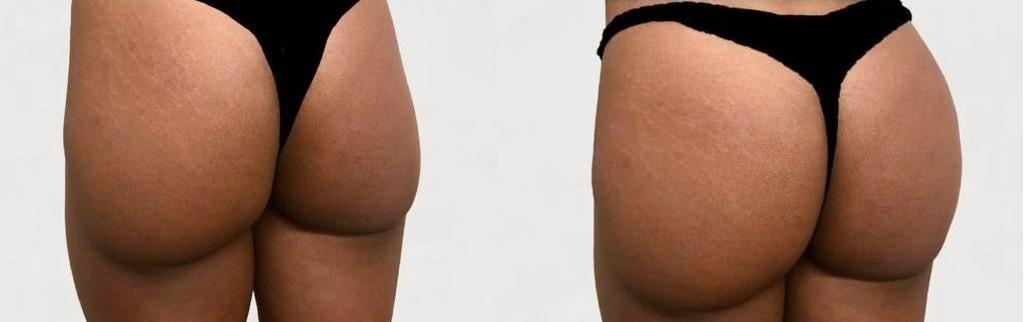 Augmentation des fesses avec fillers