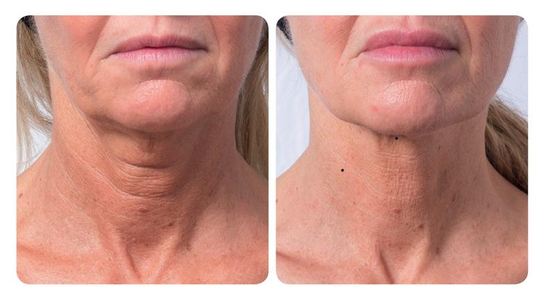 Profhilo avant après