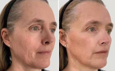 Profhilo avant après