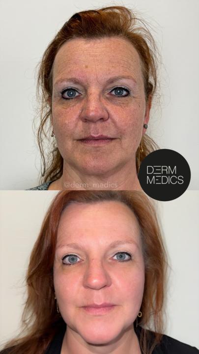 Renew & Refresh: 10% korting met code RENEW10