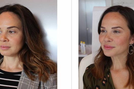Redéfinir la mâchoire : fillers, laser ou fils tenseurs