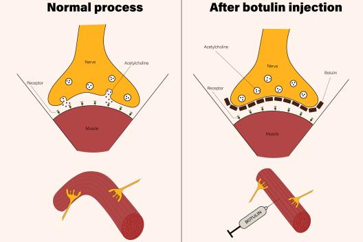 Comment fonctionne le Botox ?