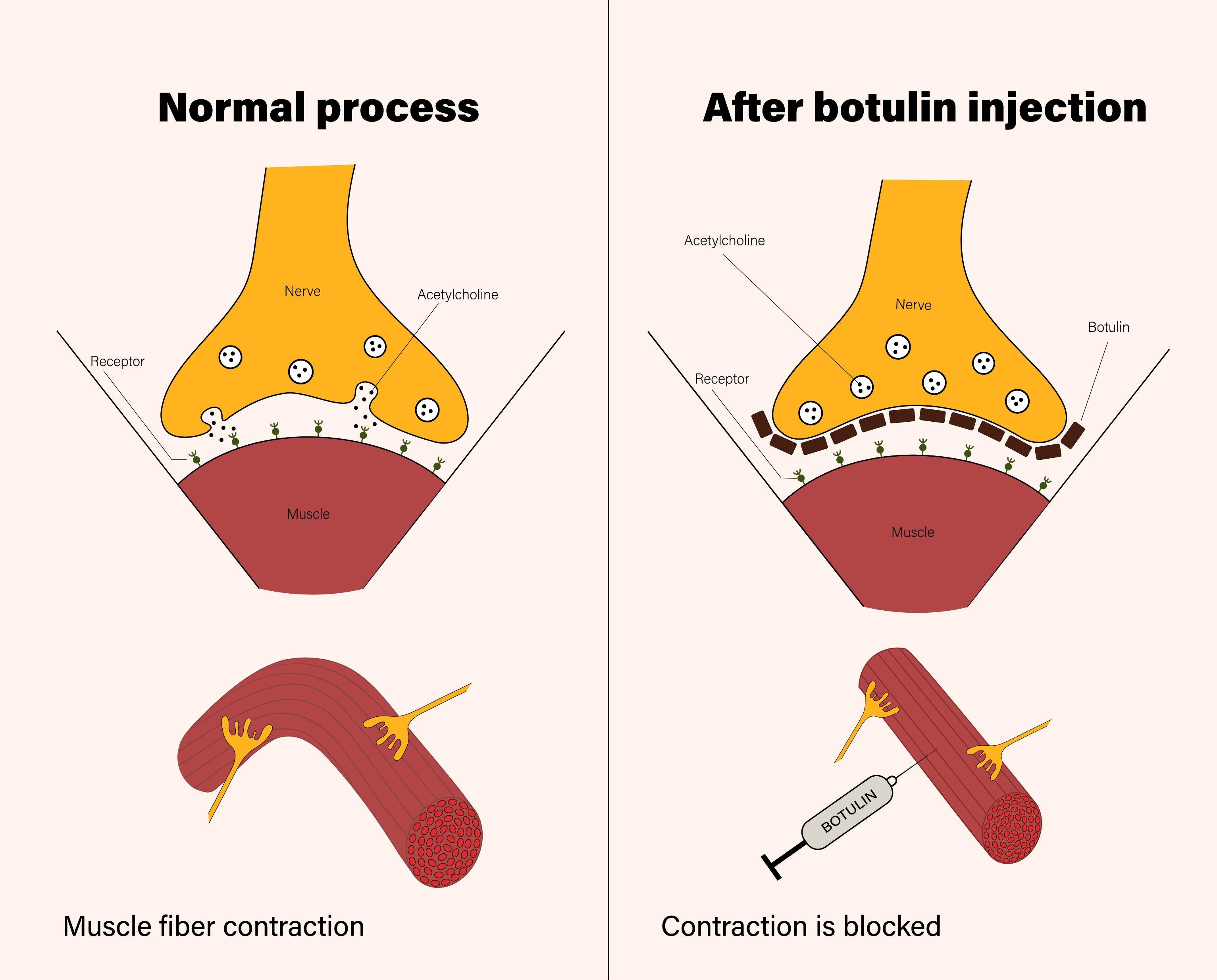 Comment fonctionne le Botox ?