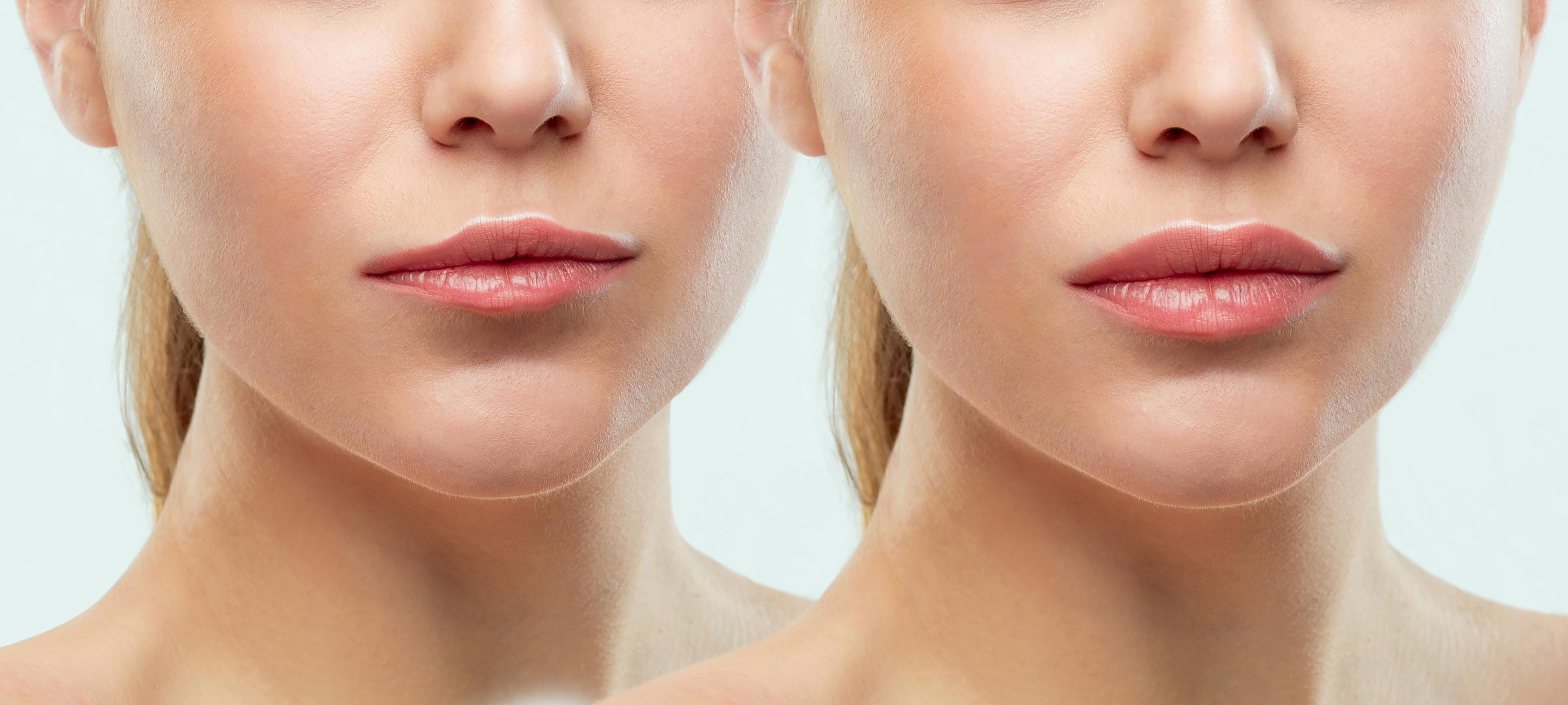 Prix des lip fillers