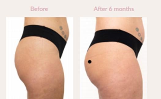 Aumento dei glutei con filler