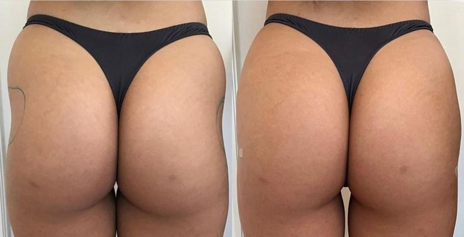 Aumento dei glutei con filler