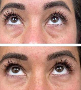 Relleno de ojeras antes y después