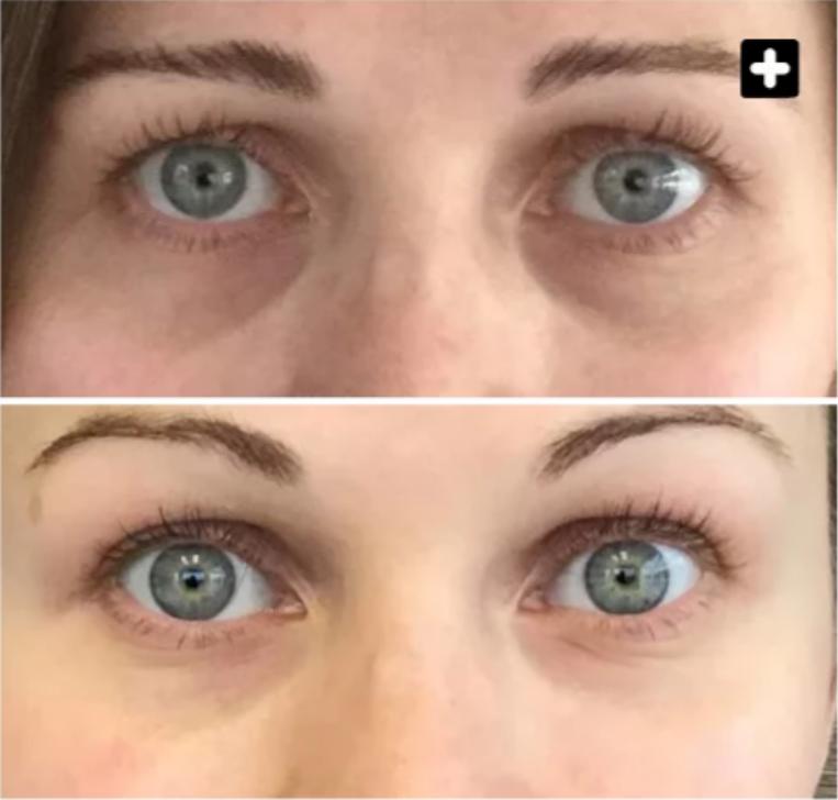 Relleno de ojeras antes y después