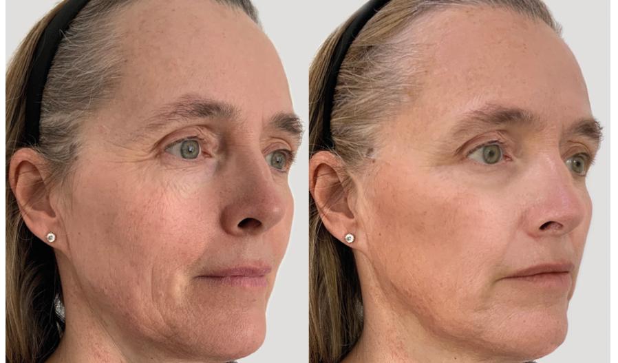 Profhilo Structura rigenera la pelle dall’interno