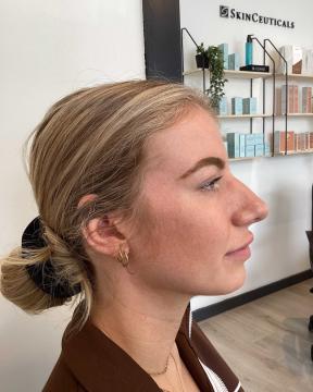 Kin fillers voor/na van Dream Fillers (voor)