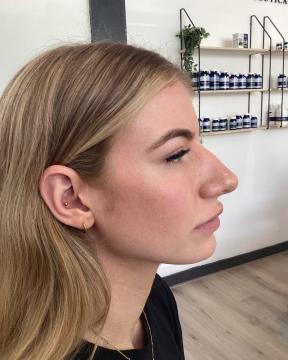 Kin fillers voor/na van Dream Fillers (na)