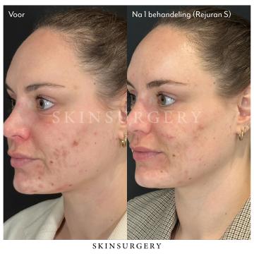 Rejuran foto van SkinSurgery Clinics Bergschenhoek (na)