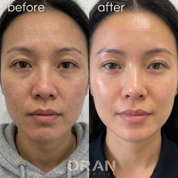 Rejuran foto van Oran Aesthetics (na)