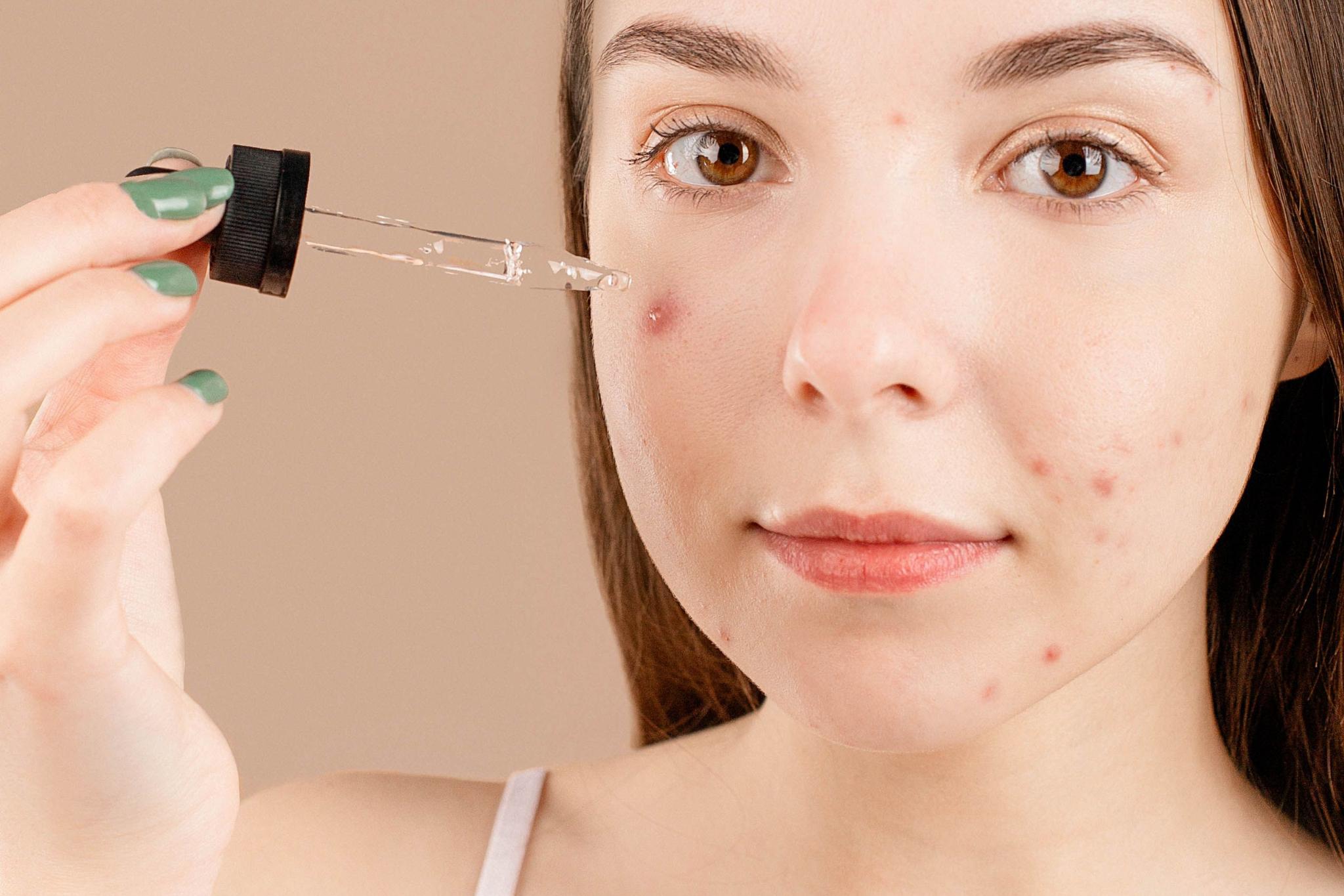 Rejuran for acne scars