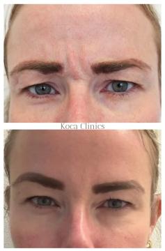 fronsrimpels voor/na van Koca Clinics Den Bosch (voor)