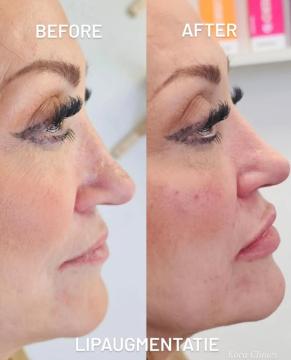 Lippen Opvullen voor/na van Koca Clinics Tiel (voor)