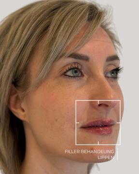 Lippen opvullen foto van ØSK Clinic (na)