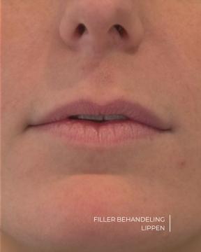 Lippen opvullen foto van ØSK Clinic (voor)