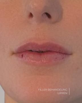 Lippen opvullen foto van ØSK Clinic (na)