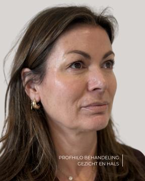 Profhilo foto van ØSK Clinic (voor)