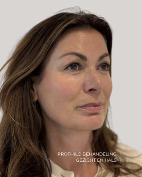 Profhilo foto van ØSK Clinic (na)