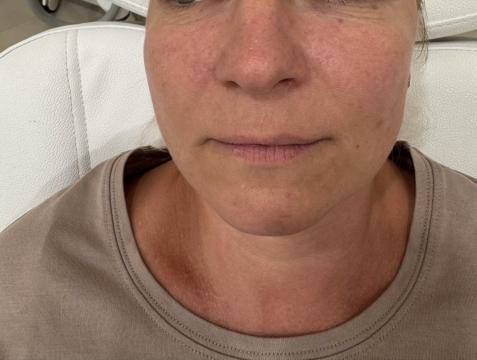 Photo Augmentation des lèvres de SW Clinic (avant)