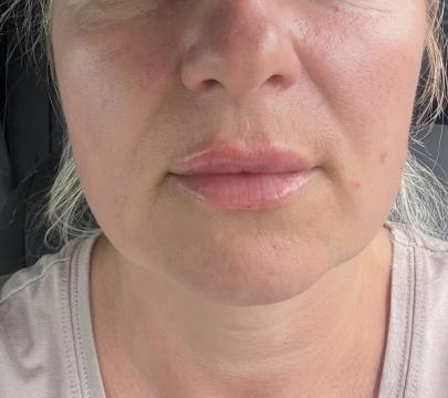 Photo Augmentation des lèvres de SW Clinic (après)