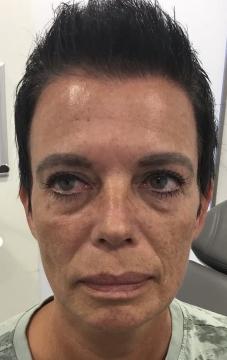 fillers voor/na van DM Aesthetics (voor)