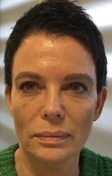 fillers voor/na van DM Aesthetics (na)