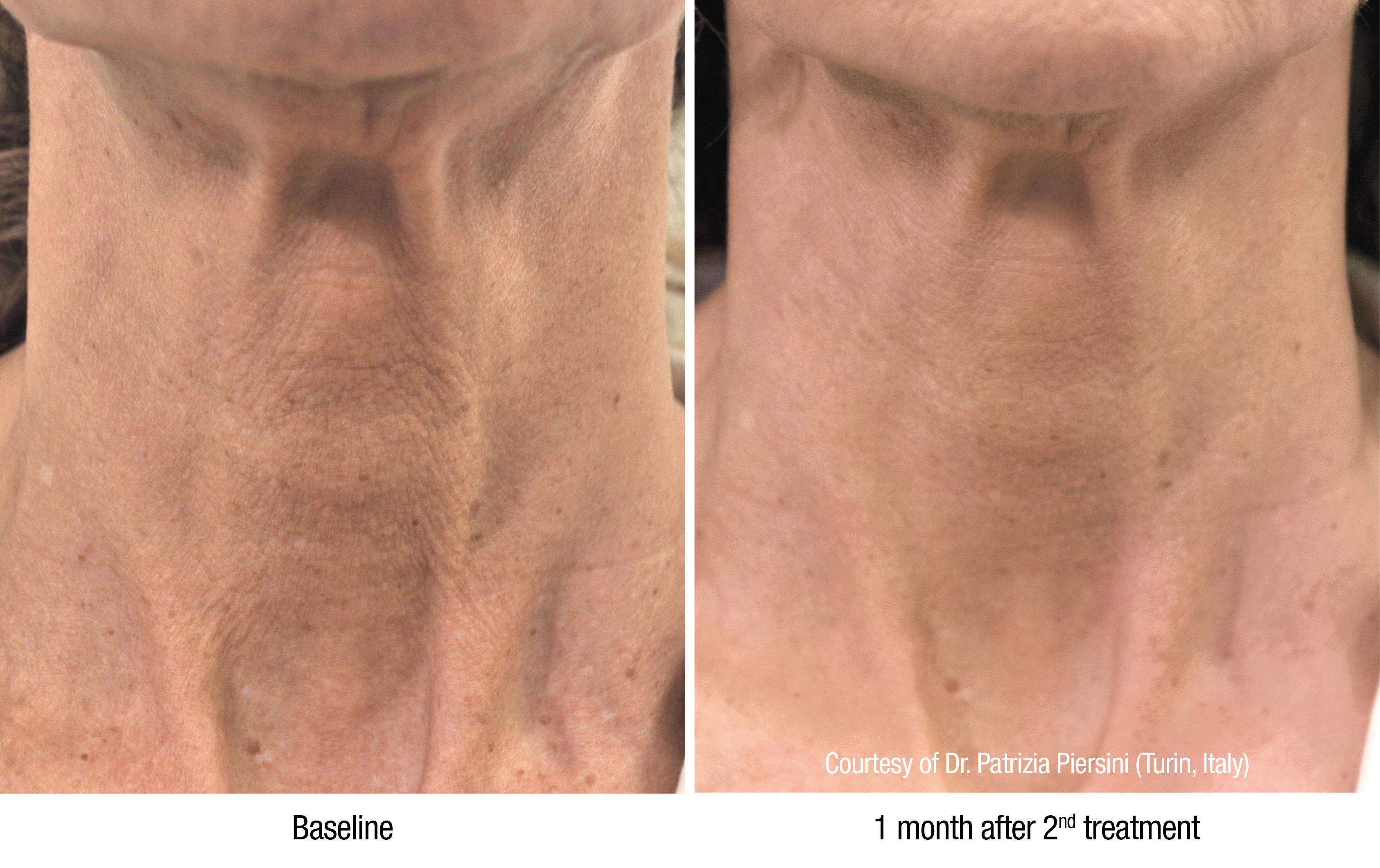 Profhilo Body behandeling