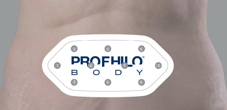 Profhilo Body behandeling