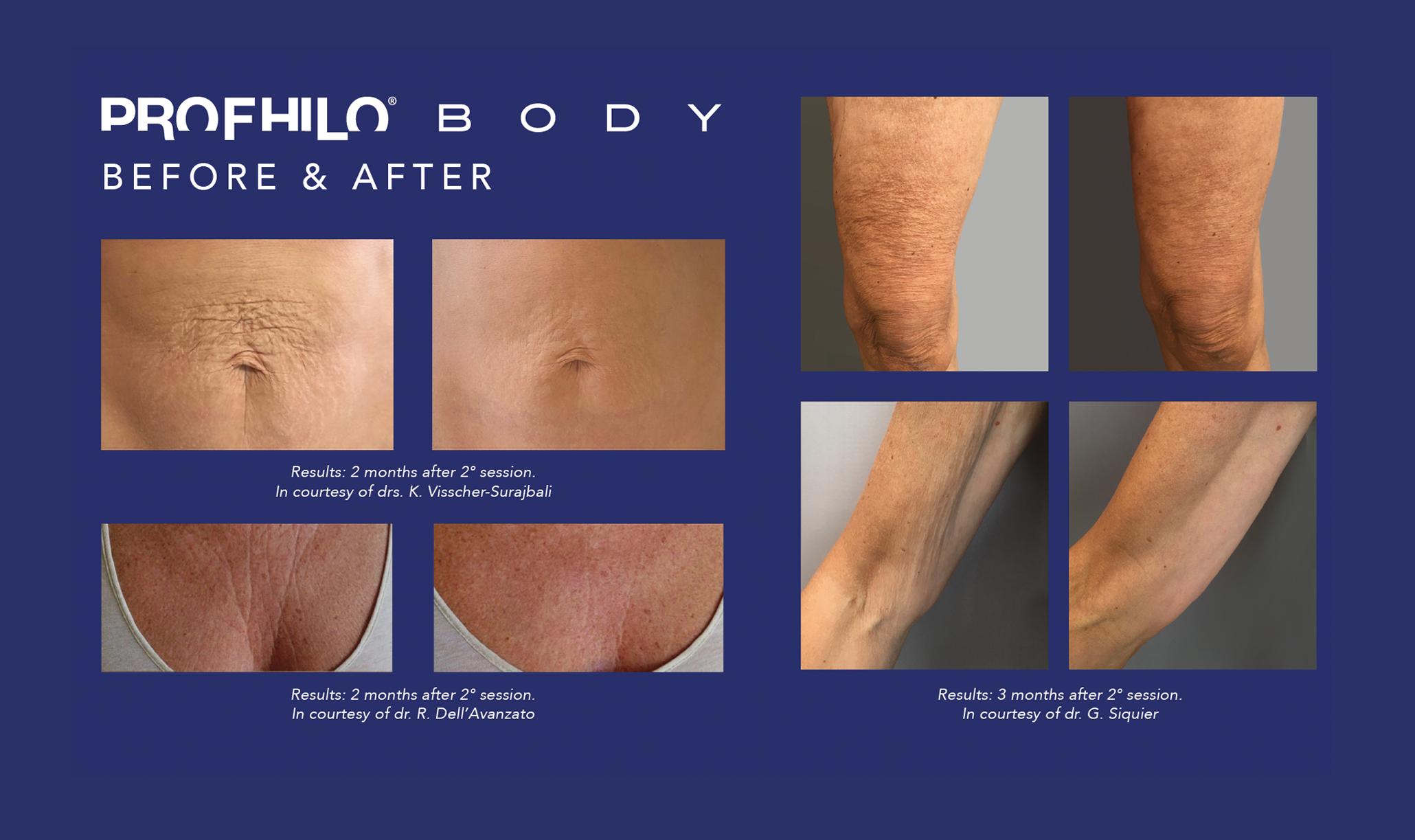 Profhilo Body behandeling