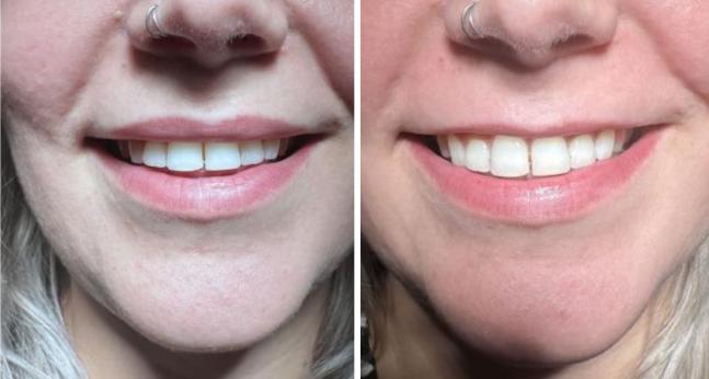 Lip flip met botox: wat kun je verwachten?