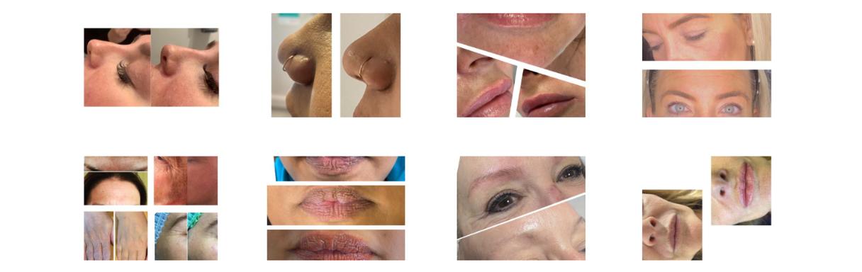 Injectables treatment for wrinkles in Hornchurch at CLINIC YOUNG Aesthetics and laser