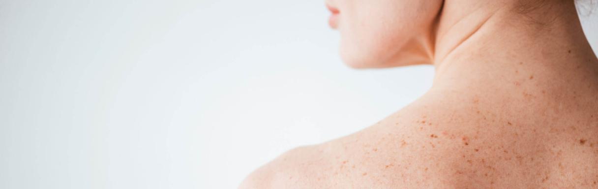 Injektionsbehandlung gegen Falten in Frankfurt am Main bei Dermatology and Aesthetic Medicine at the Alte Oper Private Practice – MVZ Dermatologie Südbayern GmbH
