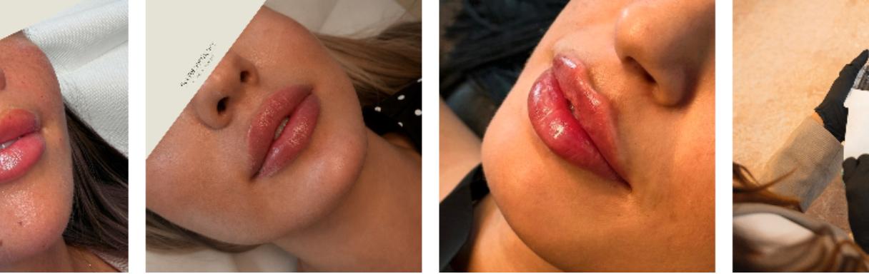 Injektionsbehandlung gegen Falten in Köln bei Secret Aesthetics - Ärztin Frau Dr. Sohal Temori