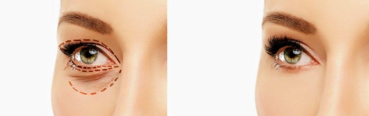 Injectables treatment for wrinkles in Swindon at Elena Prousskaia Cosmetic Surgery Swindon