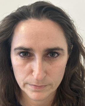 Botox foto van Kliniek Zuyd (na)