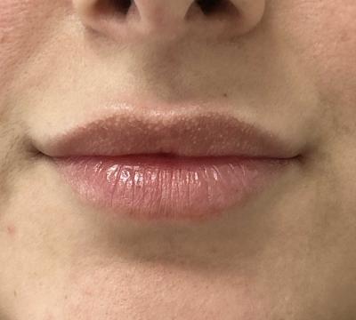 Lipfillers voor/na van Kliniek Zuyd (voor)