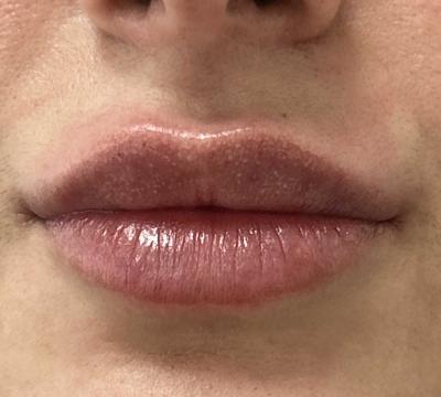 Lipfillers voor/na van Kliniek Zuyd (na)