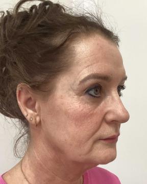 Fillers voor/na van Kliniek Zuyd (voor)