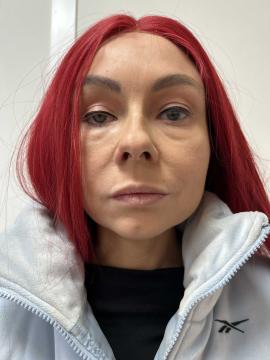 Lipfillers foto van Kliniek Zuyd (voor)