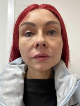 Lipfillers foto van Kliniek Zuyd (na)