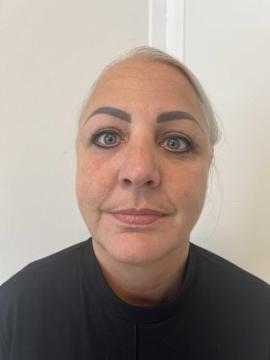 Lipfillers foto van Kliniek Zuyd (voor)